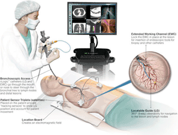 Imagen: El sistema superDimension iLogic ENB (Fotografía cortesía de Covidien). Imagen: El sistema superDimension iLogic ENB (Fotografía cortesía de Covidien).